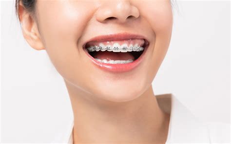 metal brackets dental|dental braces traditional metal.